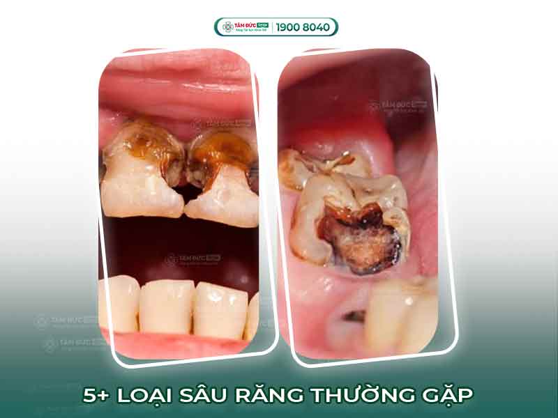 Các loại sâu răng thường gặp và cách điều trị hiệu quả tại Nha khoa Tâm Đức Smile