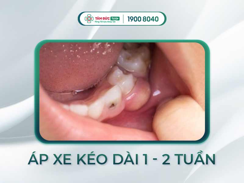 Áp xe răng có tự khỏi không? Giải đáp nguyên nhân, triệu chứng và cách điều trị