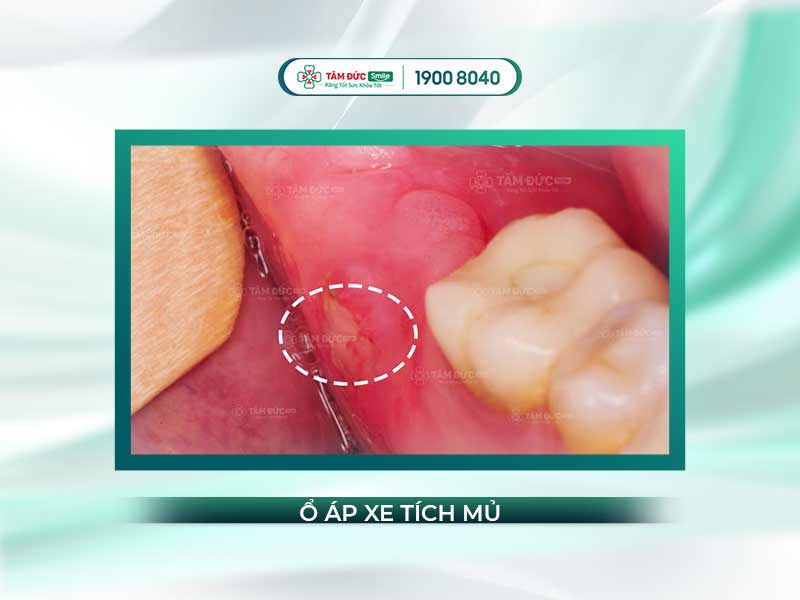 Áp xe răng khôn: Dấu hiệu, nguyên nhân và cách điều trị hiệu quả tại nha khoa