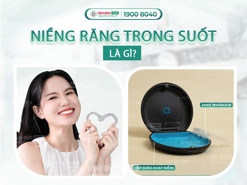 Niềng răng trong suốt: Phương pháp hiện đại, thẩm mỹ và tiện lợi nhất hiện nay