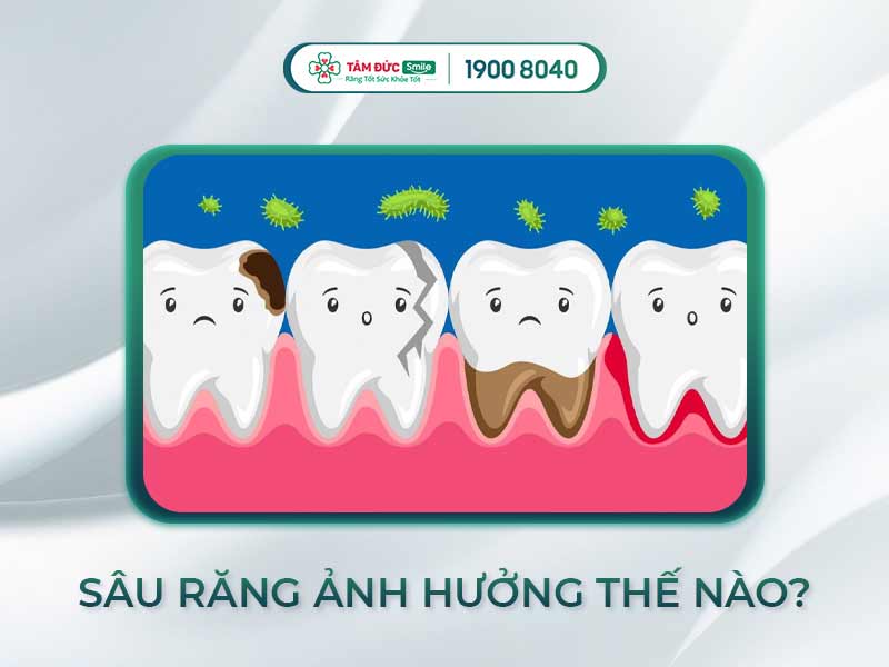 Bệnh sâu răng có lây không? Nguyên nhân, đường lây và cách phòng ngừa hiệu quả