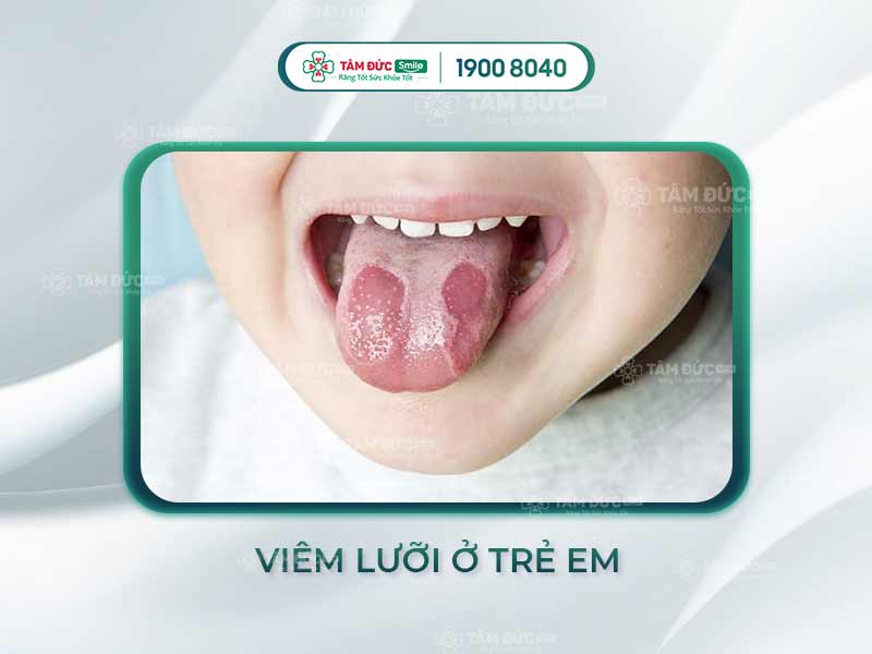 Bệnh về lưỡi ở trẻ em: Dấu hiệu, nguyên nhân và cách xử lý hiệu quả cho bé