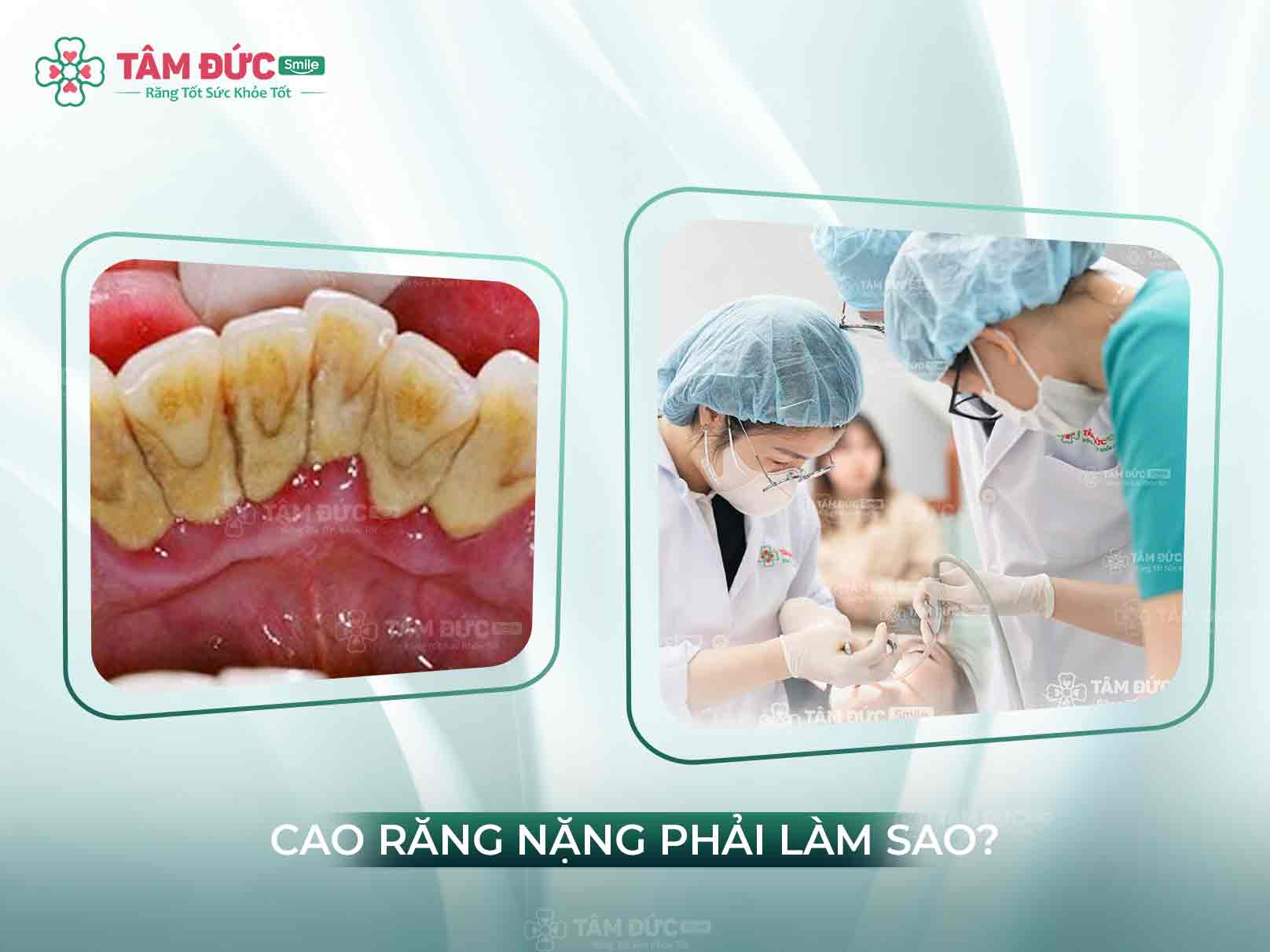 Cao răng nặng: Nguyên nhân, biến chứng và cách điều trị