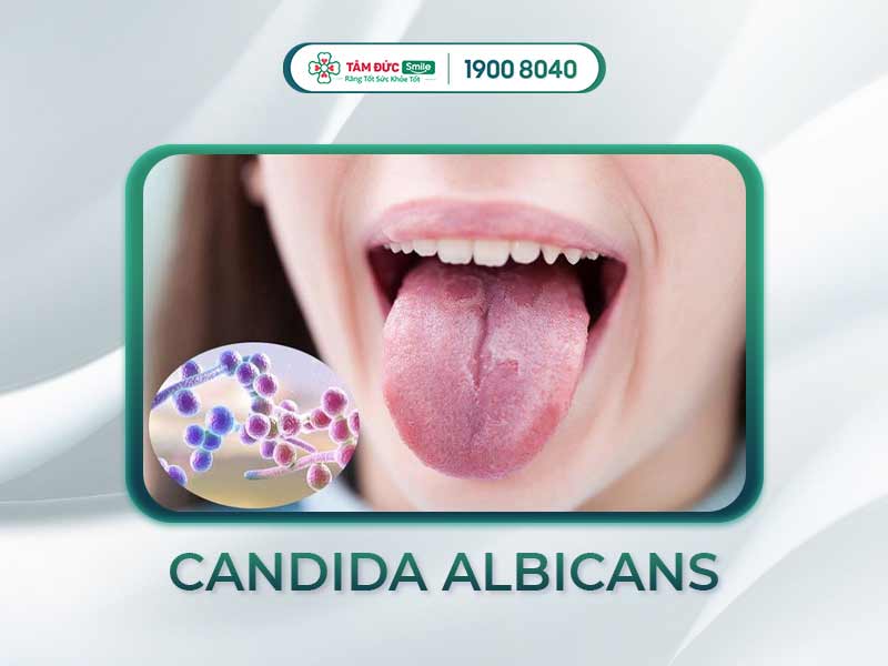 Nhiễm nấm Candida miệng: Dấu hiệu, nguyên nhân và cách điều trị hiệu quả