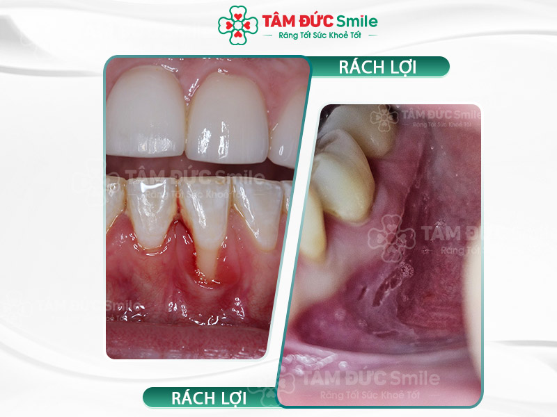 Rách lợi chảy máu, sưng đau: Nguyên nhân, dấu hiệu và cách xử lý hiệu quả