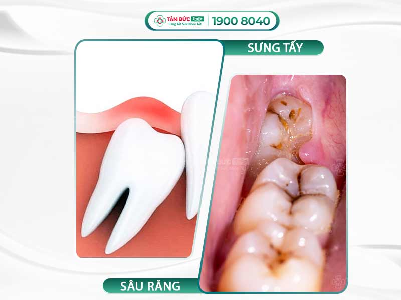 Sưng nướu răng trong cùng: Nguyên nhân, dấu hiệu và cách điều trị hiệu quả