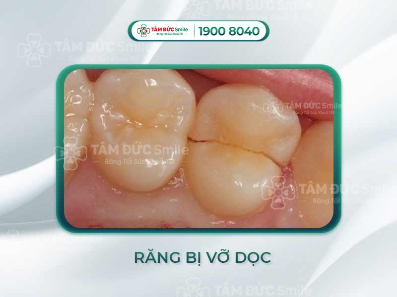 Răng bị vỡ dọc: Nguyên nhân, triệu chứng và phương án điều trị hiệu quả nhất
