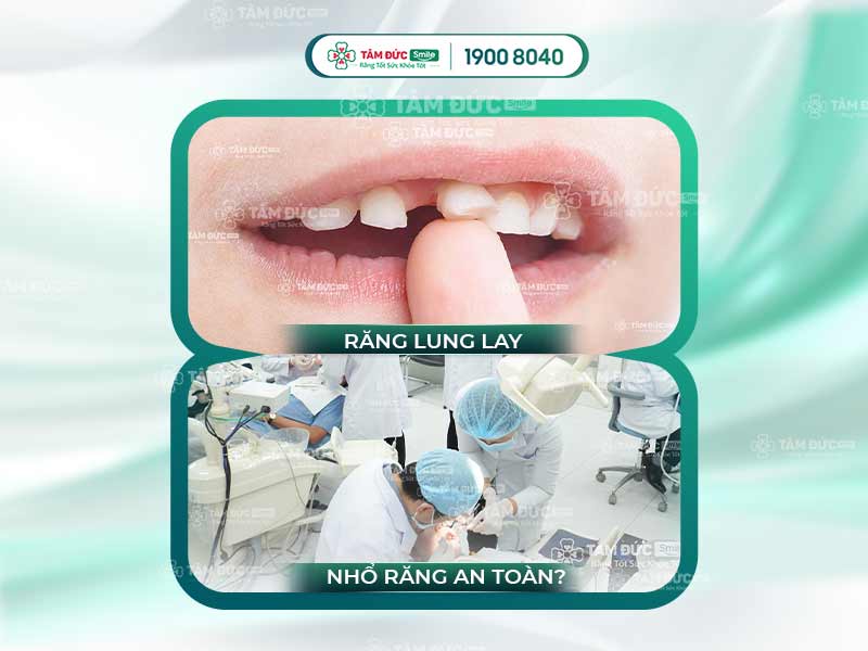 Cách nhổ răng lung lay an toàn, không đau cho trẻ em và người lớn tại nhà