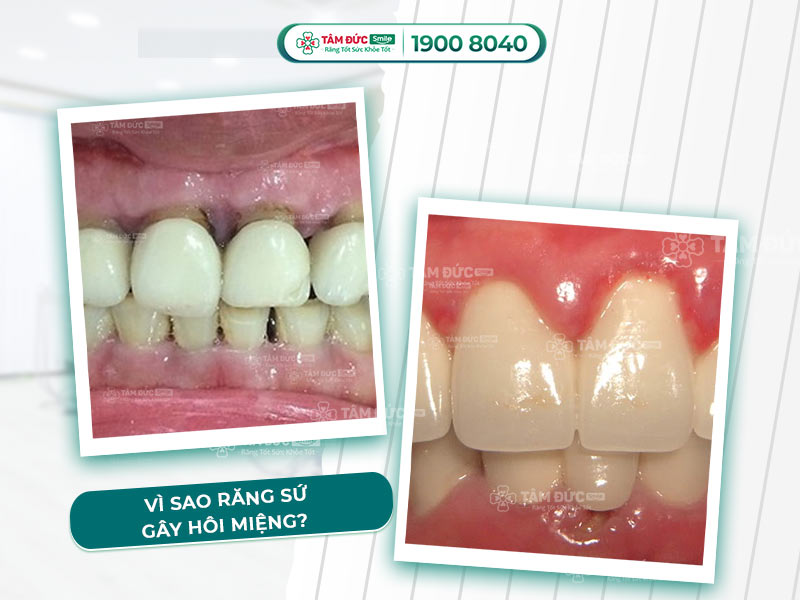 Bọc răng sứ có bị hôi miệng không? Nguyên nhân & cách xử lý hiệu quả nhất