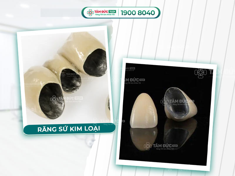 Bọc răng sứ kim loại giá bao nhiêu? Ưu nhược điểm & bảng giá