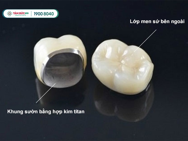RĂNG SỨ TITAN LÀ GÌ? ƯU NHƯỢC ĐIỂM VÀ NHỮNG ĐIỀU CẦN BIẾT
