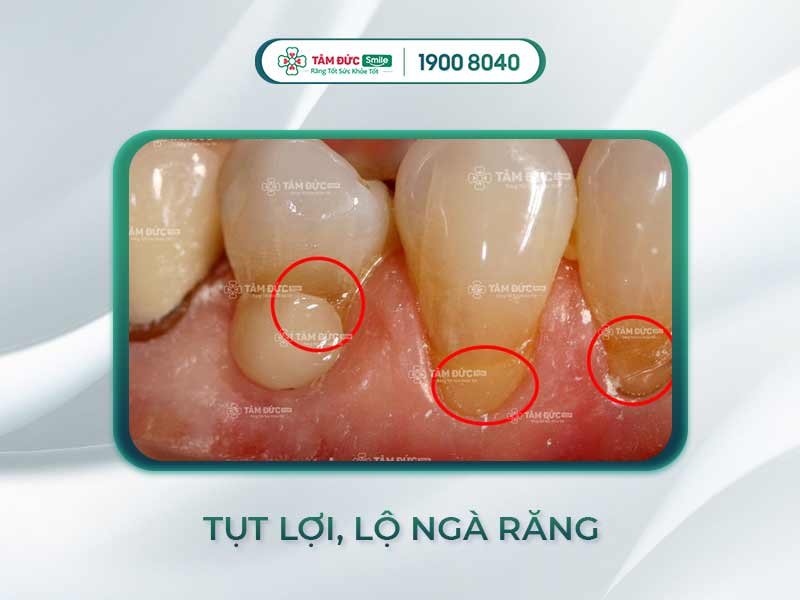 Răng lộ ngà: Nguyên nhân, triệu chứng và cách điều trị hiệu quả tại nha khoa