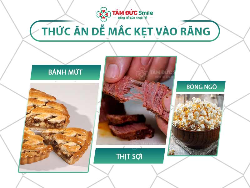 Cách lấy thức ăn dính trong răng hàm: Vệ sinh và làm sạch răng hiệu quả