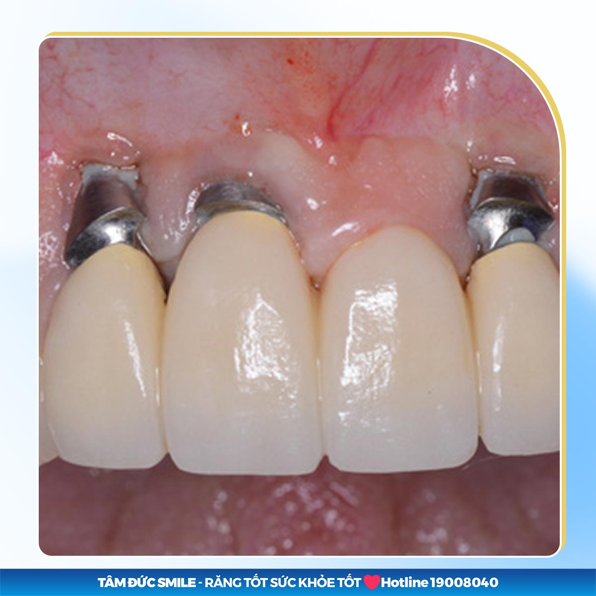 Hối hận vì trồng implant giá rẻ: Biến chứng, sai lệch và viêm nhiễm đáng sợ