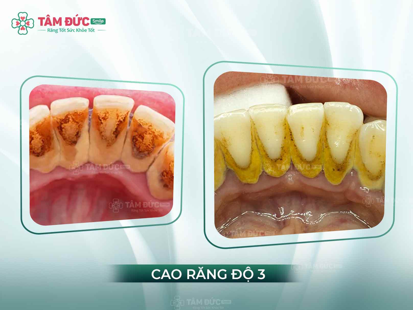 Cao răng cấp độ 3: Biểu hiện nguy hiểm, biến chứng và cách điều trị hiệu quả