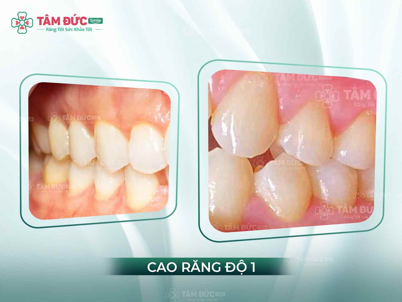 Cao răng độ 1 là gì? Triệu chứng, cách xử lý hiệu quả tại Nha khoa Tâm Đức Smile