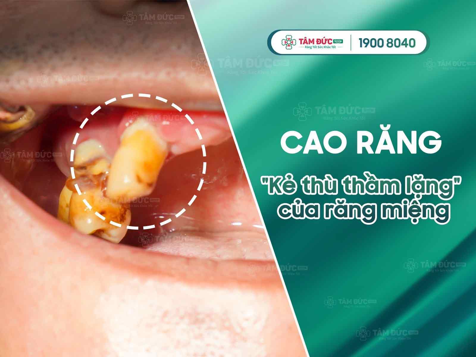 Cao răng: Nguyên nhân, tác hại và giải pháp điều trị hiệu quả