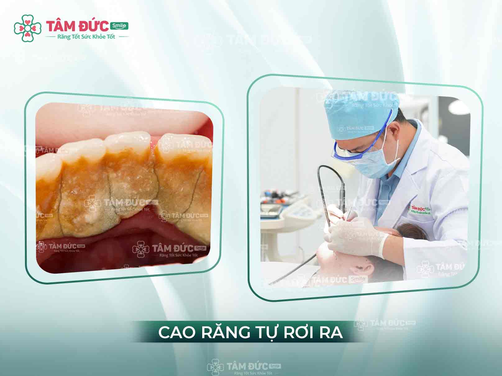 Cao răng tự rơi ra: Dấu hiệu cảnh báo viêm nướu, bệnh nha chu và tiêu xương răng