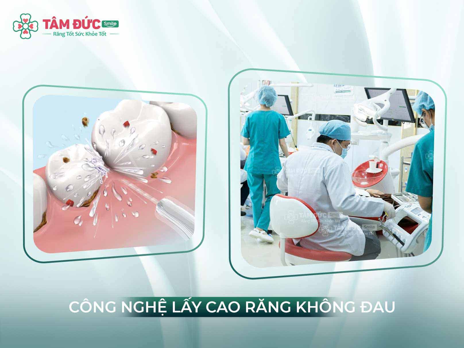 Cạo vôi răng có đau không? Cảm giác, mức độ ê buốt và cách giảm khó chịu