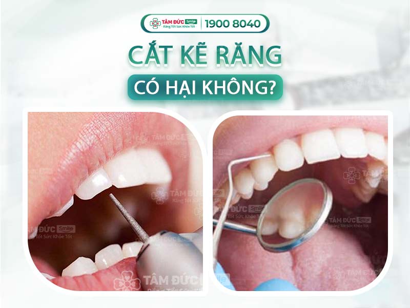 Cắt kẽ răng: Kỹ thuật tạo khoảng chỉnh nha an toàn, hỗ trợ niềng hiệu quả
