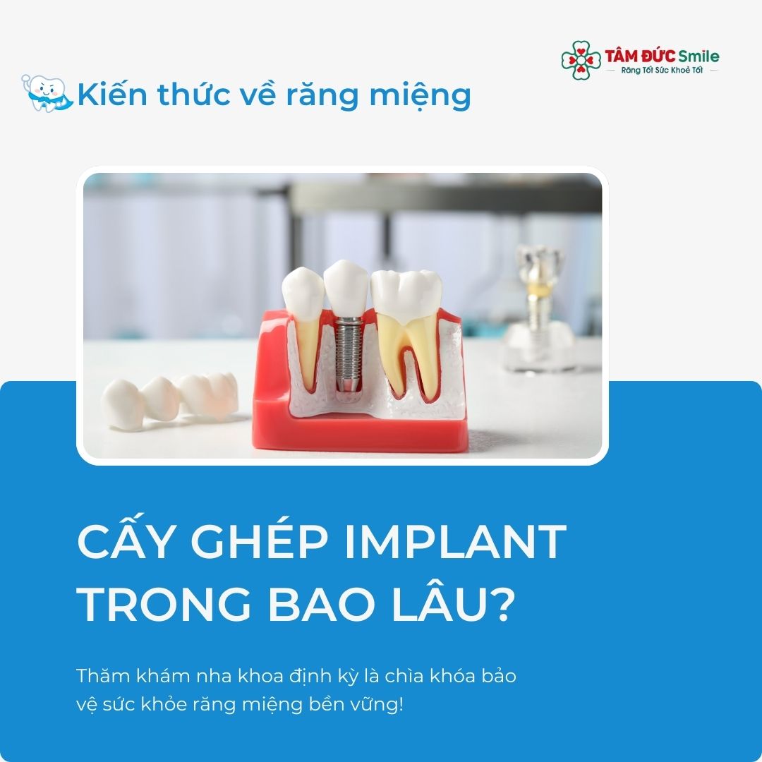 Cấy ghép Implant mất bao lâu? Quy trình – Thời gian – Hồi phục chi tiết