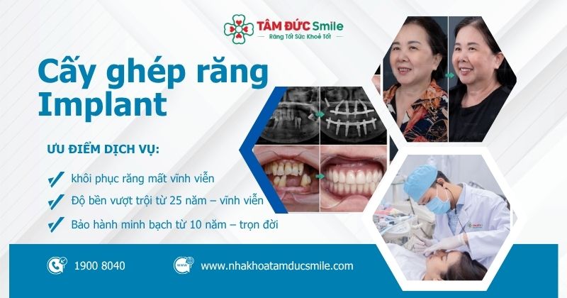 Cấy ghép răng Implant: Giải pháp trồng răng bền vững, bảo hành chính hãng