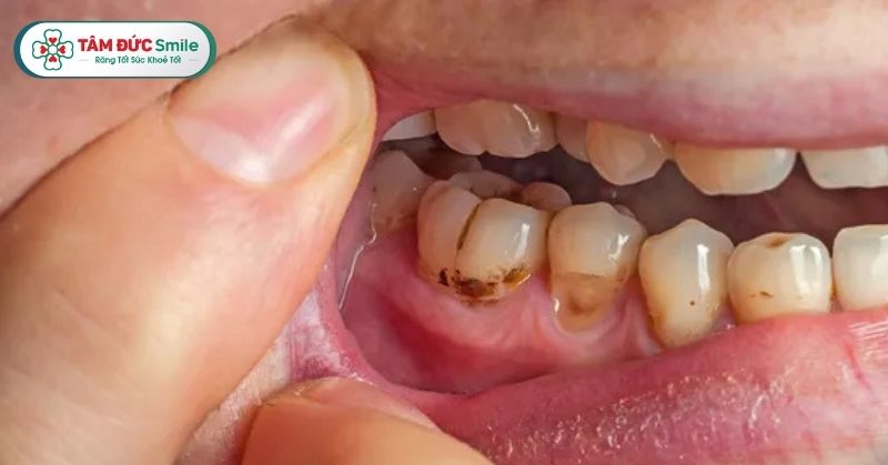Chân răng bị đen, tụt lợi, viêm nha chu: Nguyên nhân & cách chữa tại Tâm Đức Smile