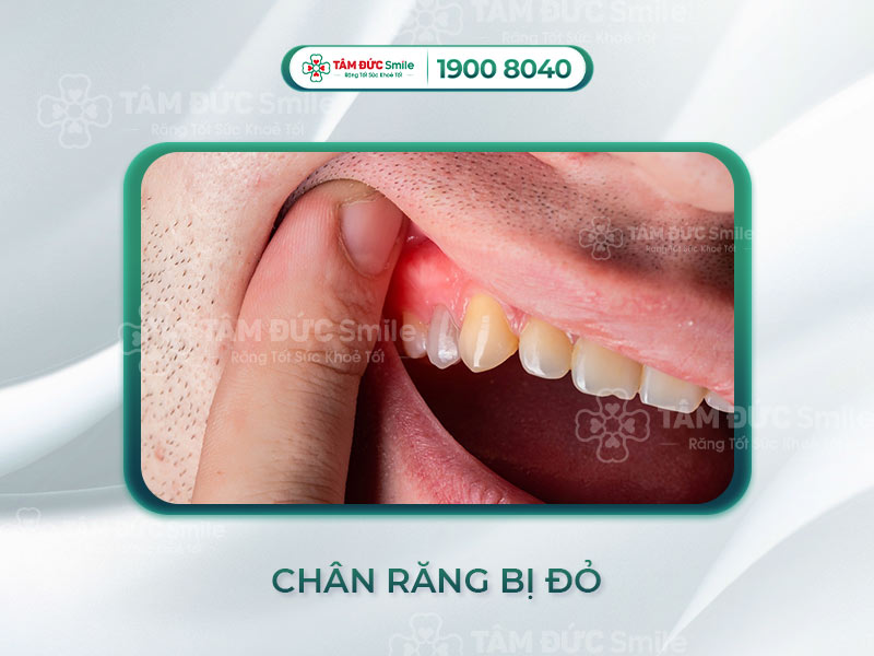 Nướu răng bị đỏ – Nguyên nhân, dấu hiệu và cách điều trị hiệu quả tại Nha khoa Tâm Đức Smile