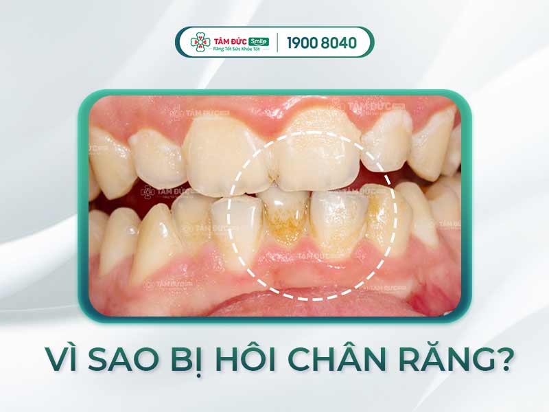 Chân răng có mùi hôi, viêm nướu, tụ mủ – Nguyên nhân do đâu và cách điều trị?