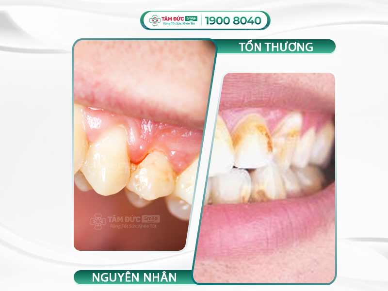 Chảy máu chân răng: Nguyên nhân, dấu hiệu và cách điều trị hiệu quả nhất