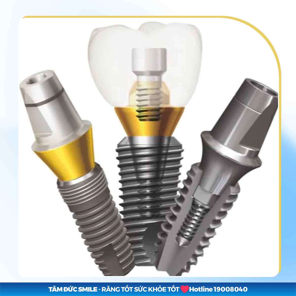 Abutment Implant giá bao nhiêu? Chi phí trụ phục hình Implant mới nhất