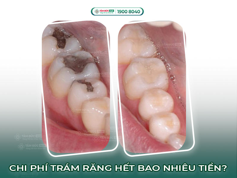 Trám răng sâu giá bao nhiêu? Bảng giá trám răng composite tại Tâm Đức Smile