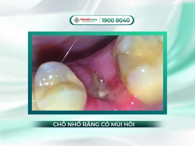 Hôi miệng sau khi nhổ răng: Nguyên nhân, dấu hiệu và cách xử lý hiệu quả