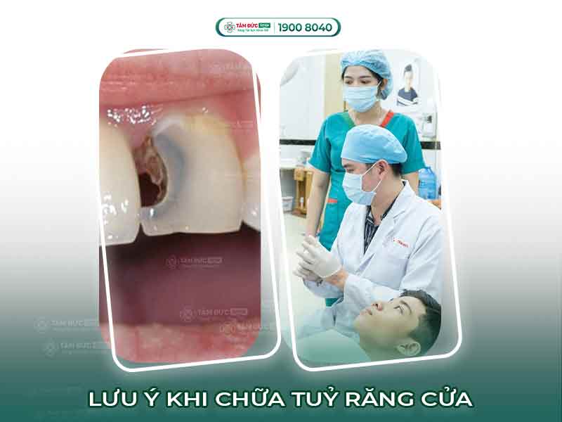 Chữa tủy răng cửa: Quy trình, chi phí, dấu hiệu và cách điều trị hiệu quả nhất