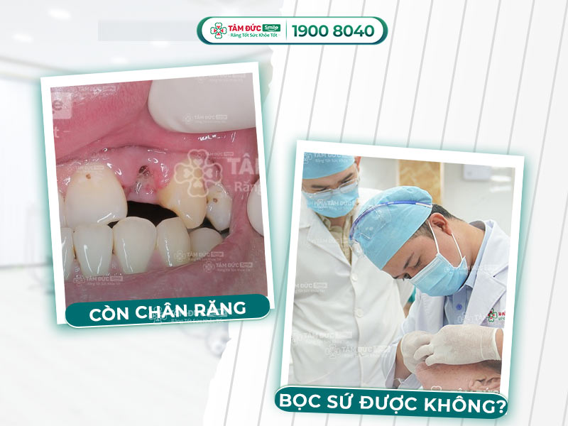 Còn chân răng bọc sứ được không? Điều kiện và giải pháp