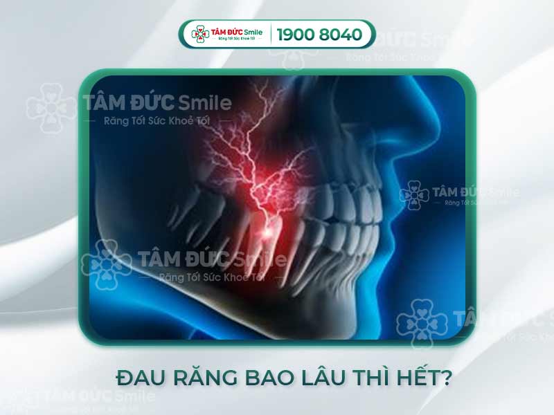 Cơn đau răng kéo dài bao lâu? Khi nào cần đi khám và xử lý triệt để?