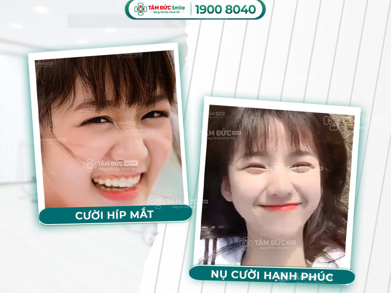 Mắt híp khi cười: Nguyên nhân, giải pháp và thẩm mỹ nụ cười tại Tâm Đức Smile
