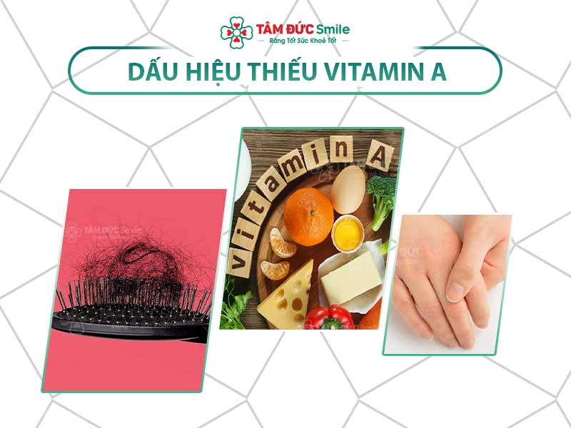 Biểu hiện thiếu Vitamin A: Nguyên nhân, triệu chứng và cách bổ sung hiệu quả