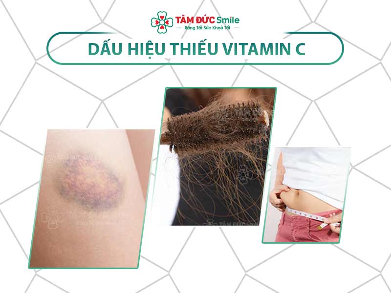 Thiếu vitamin C: Dấu hiệu, nguyên nhân và biến chứng răng miệng cần lưu ý