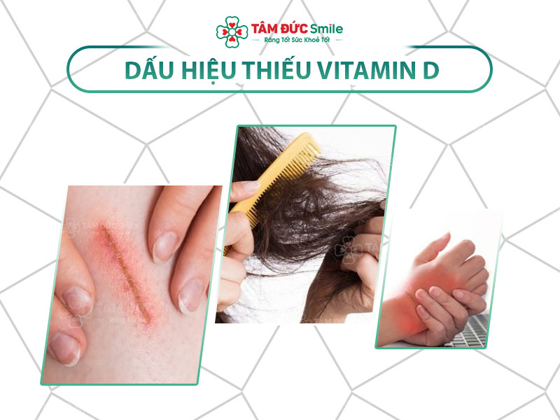 Thiếu vitamin D: Biểu hiện, nguyên nhân và cách khắc phục hiệu quả cho mọi đối tượng