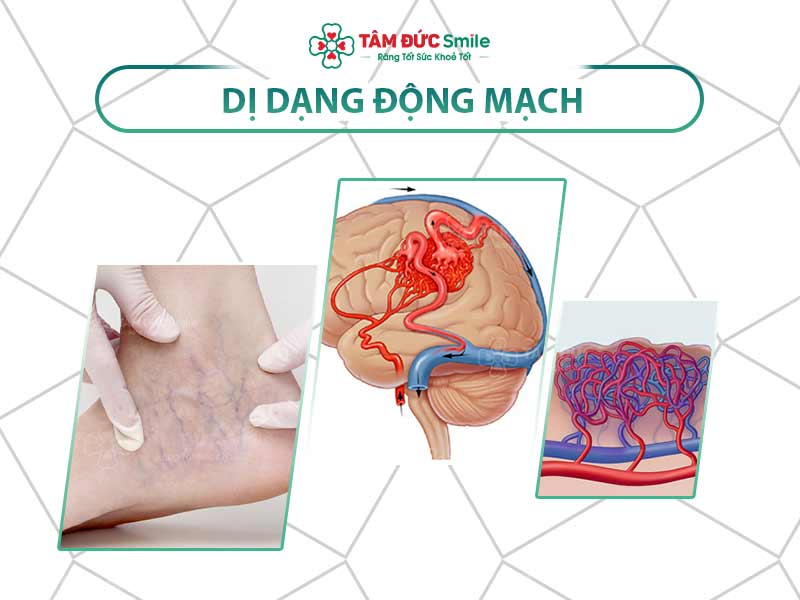 Dị dạng mạch máu: Nguyên nhân, triệu chứng và cách điều trị hiệu quả hiện nay