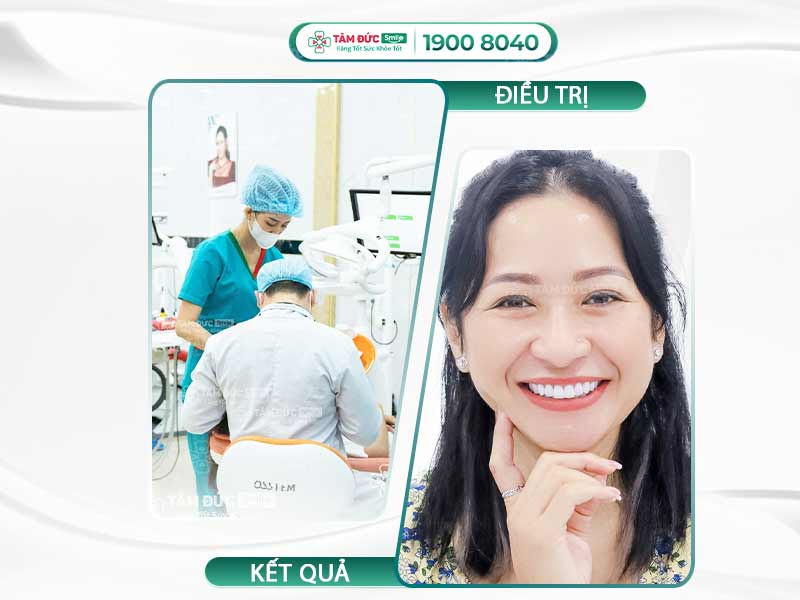 Cắt chóp răng: Giải pháp giữ lại răng thật khi điều trị tủy không thành công