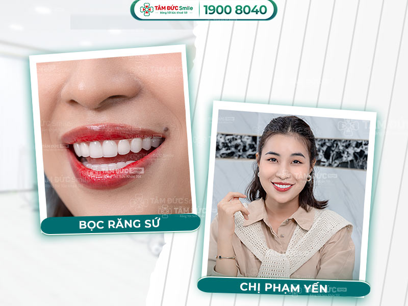 Làm răng sứ Đà Lạt: Bọc răng sứ thẩm mỹ, zirconia, cercon tại Nha khoa uy tín