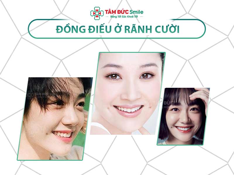 Đồng điếu ở rãnh cười tốt hay xấu? Có ý nghĩa gì?