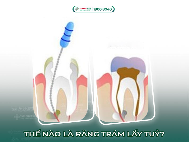 Trám răng lấy tủy: Quy trình, chi phí và lưu ý khi phục hồi răng tổn thương