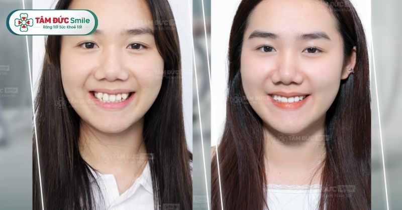 Bảng giá niềng răng Đà Nẵng mới nhất tại Nha khoa Tâm Đức Smile – Ưu đãi hấp dẫn