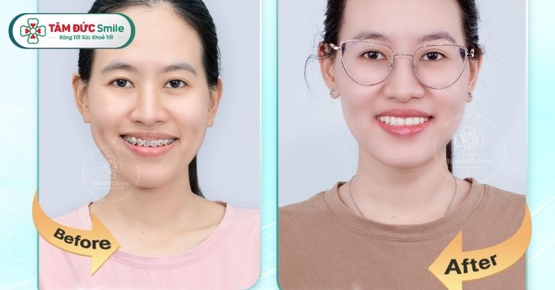 Giá niềng răng Nha Trang mới nhất tại Nha khoa Tâm Đức Smile – Ưu đãi hấp dẫn