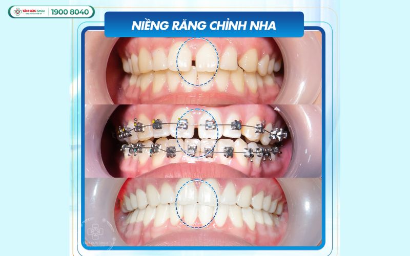 gia-nieng-rang-thua-ham-tren-2