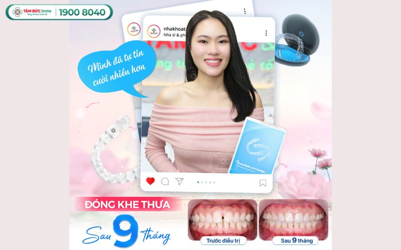gia-nieng-rang-thua-ham-tren-3