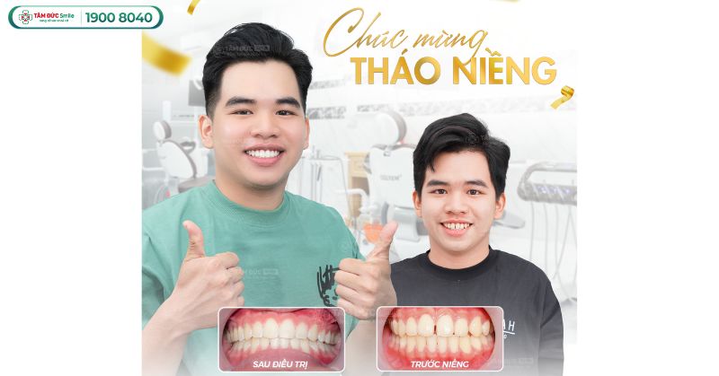 Giá niềng răng thưa hàm trên bao nhiêu? Phân tích chi tiết theo từng phương pháp